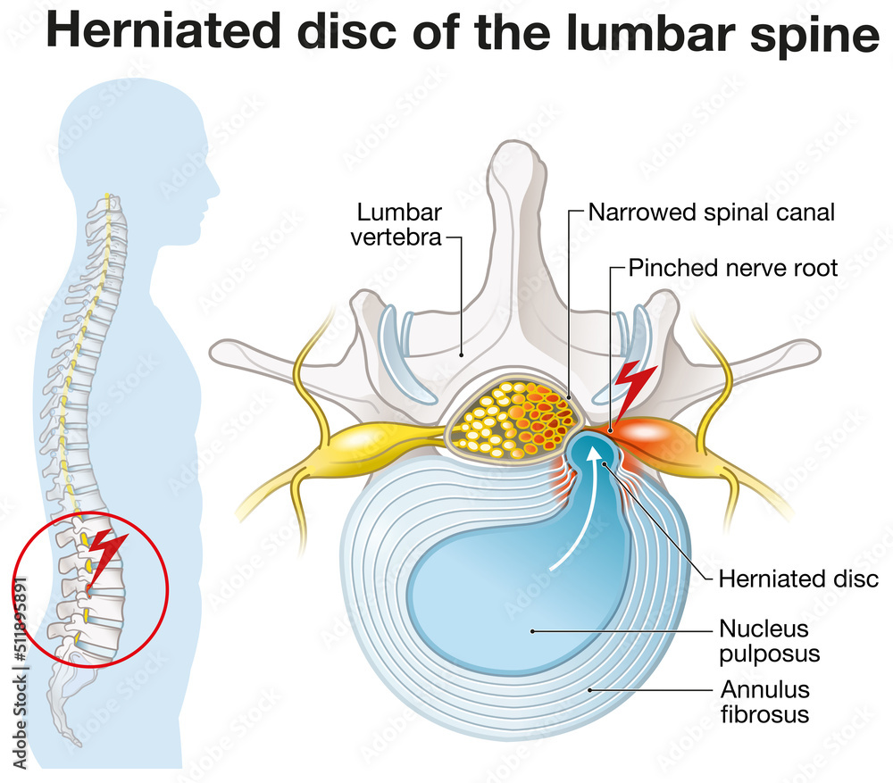 Herniated disc of the lumbar spine, stenosis, slipped disc, labeled ...