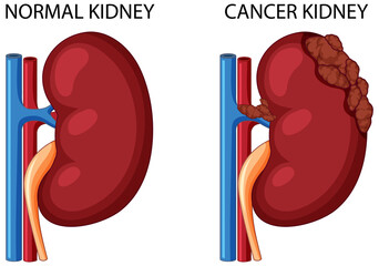 Wall Mural - Normal kidney and cancer kidney