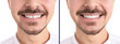 © New Africa - Collage with photos of man with diastema between upper front teeth before and after treatment on white background, closeup. Banner design