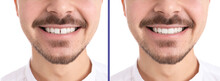 Collage With Photos Of Man With Diastema Between Upper Front Teeth Before And After Treatment On White Background, Closeup. Banner Design