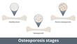 Osteoporosis stages. Disease develops when bone mineral density and bone mass decrease. Visualization includes healthy bone, osteoporosis, and severe osteoporosis.