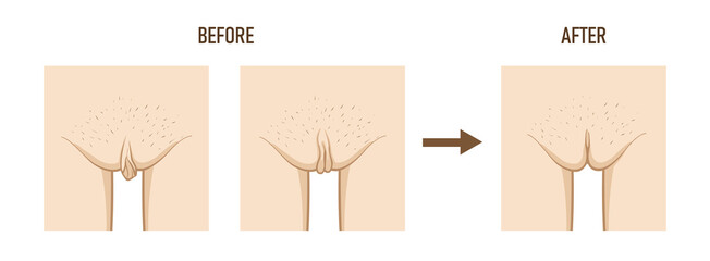 Labioplasty (vaginoplasty). Changes in the female labia, before and after