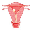 Sessile Polyp in the uterus Female reproductive system in cross sections. Front view in a cut. Human anatomy diseases internal organs location scheme, cervix, ovary, fallopian tube flat style icon
