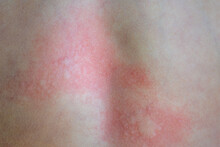 Urticaria On The Skin. Red Spots Of An Allergic Reaction On The Skin Of A Child. Urticaria Symptoms Close Up