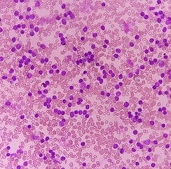 Canvas Print - Acute leukemia, peripheral blood smear show most of cell are blast cell with abundant cytoplasm, variable chromatin present.