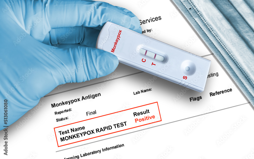 Positive Monkeypox rapid test result by using rapid testing cassette to ...
