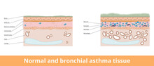 Normal And Bronchial Asthma Tissue. Visualization Of Difference Between Normal And Bronchial Asthma Tissues, Including Goblet Cells And Smooth Muscle, Lamina Propia And Mast Cells.