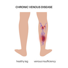 Poster - Varicose veins treatment