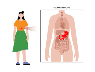 Wall Mural - Stomach polyp disease