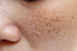 Woman's problematic skin pore and dark spots on the face