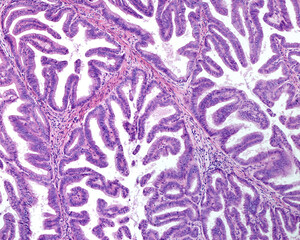 Sticker - Human uterus. Endometroid carcinoma