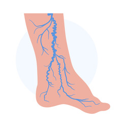 Poster - Varicose veins treatment