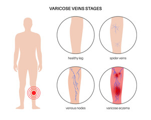 Sticker - Varicose veins treatment