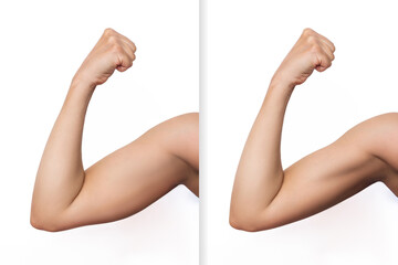 Two shots of a young woman with excess fat on her arm and toned arm before and after losing weight isolated on a white background. Result of diet, liposuction, training, workouts. Plastic surgery