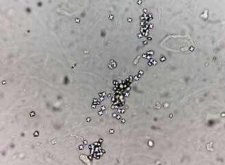 Sticker - Microscopic image showing Calcium oxalate crystal from urine sediment.