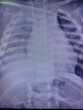 Film x-ray show right pleural effusion for medical and technology concept 