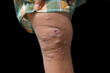 Scabies Infestation with secondary or superimposed bacterial infection and pustules in leg of Asian, Burmese child.