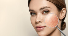 Magnifying Glass Showing Couperose On Face Skin. Woman Showing Problems Couperose-prone Sensitive Skin