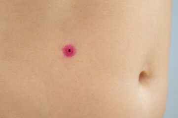 Wall Mural - Close-up of a removed wart on a woman's abdomen. Human papillomavirus after burning.