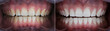 Leinwandbild Motiv dental photo comparison before and after teeth whitening