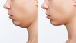 © Марина Демешко - Liposuction of the double chin. Cropped shot of woman's face with chin before and after cosmetic plastic surgery isolated on a white background. The result of lifting. Fat removal, weight loss