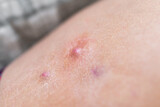 Fototapeta Na ścianę - Macro closeup of red swollen boil pimple on leg skin of female woman showing medical condition called hidradenitis suppurativa