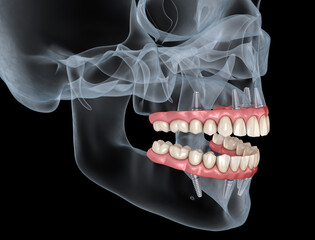 Wall Mural - Maxillary and Mandibular prosthesis with gum All on 4 system supported by implants. Medically accurate 3D illustration of human teeth and dentures