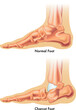 Medical illustration shows the difference between a normal foot and a charcot foot.