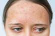 © Марина Демешко - Close up of red rash on a forehead. Cropped shot of a young woman's face with acne problem. Allergies, pimples, hormonal changes. Problem skin, care and beauty concept. Dermatology, cosmetology