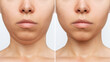 © Марина Демешко - Liposuction of the double chin. Cropped shot of a woman's face with chin before and after cosmetic plastic surgery isolated on a white background. The result of lifting, fat removal, weight loss
