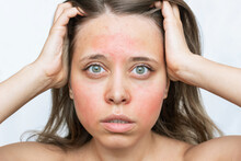 A Young Caucasian Worried Woman With A Red Allergic Rash On Her Cheeks And Forehead Isolated On White Background. Allergy On The Face. Allergic Reaction To Food, Cosmetics, Medicines 