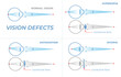 Vision defects and their correction with intraocular lenses. Vision problems with hyperopia, myopia and astigmatism. Section of an eye for ophthalmologist infographics