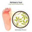 © designua - Athlete's foot. fungal infection that affects the feet.