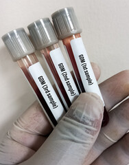 Poster - Technologist holding sample tubes of GDM(Gestational Diabetes Mellitus) test for diagnosis of hyperglycemia or hypoglycemia, oral glucose tolerance test (OGTT).