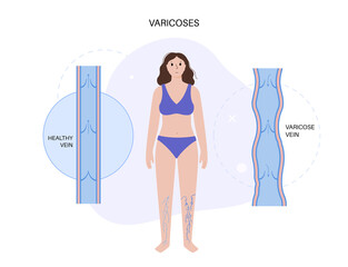 Sticker - Varicose veins treatment