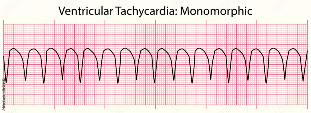 ECG line: Ventricular Tachycardia Monomorphic in 6 second ECG paper ...
