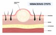 Anatomy of tumor and cancer bumps under the skin of sebaceous cyst pilar boil acne swollen