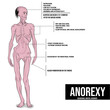 anorexia, an eating disorder that causes people to lose more weight than is considered healthy for their age and height.