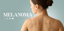Young Woman With Moles And Word MELANOMA On Grey Background