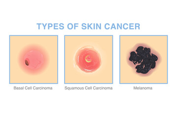 3 Types of skin cancer. Illustration about medical diagram of basal cell carcinoma, squamous cell carcinoma, and Melanoma for diagnosis and treatment of skin lesions.