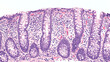 Photomicrograph of lymphocytic colitis, a type of microscopic colitis, showing increased numbers of intraepithelial lymphocytes.  This condition is associated with watery diarrhea.