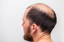 Male Head With Thinning Hair Or Alopecia