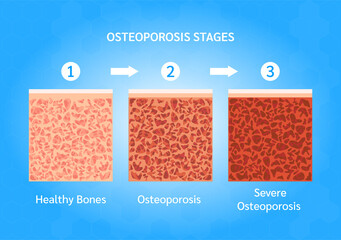 osteoporosis stages. bone structure normal and osteoporosis. medical check up health concept. isolat