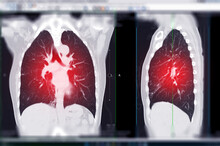CT Chest Or CT Scan Of Lung Coronal And Sagittal View.