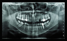 Orthopantomograph Panoramic Image Radiograph Of Teeth