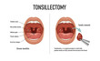 Tonsillectomy. Removal of palatine tonsils. Acute pharyngitis