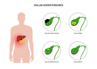 Sticker - Gallbladder diseases poster