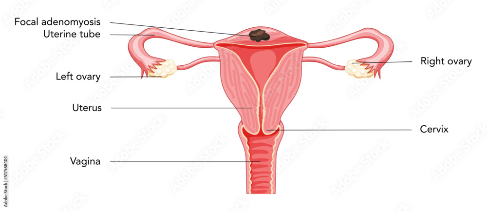 Focal Adenomyosis with inscriptions, Human anatomy Female reproductive Sick system organs. Structure of uterus, cervix, ovary, fallopian tube in Latin text. Frontal view in a cut Vector illustration