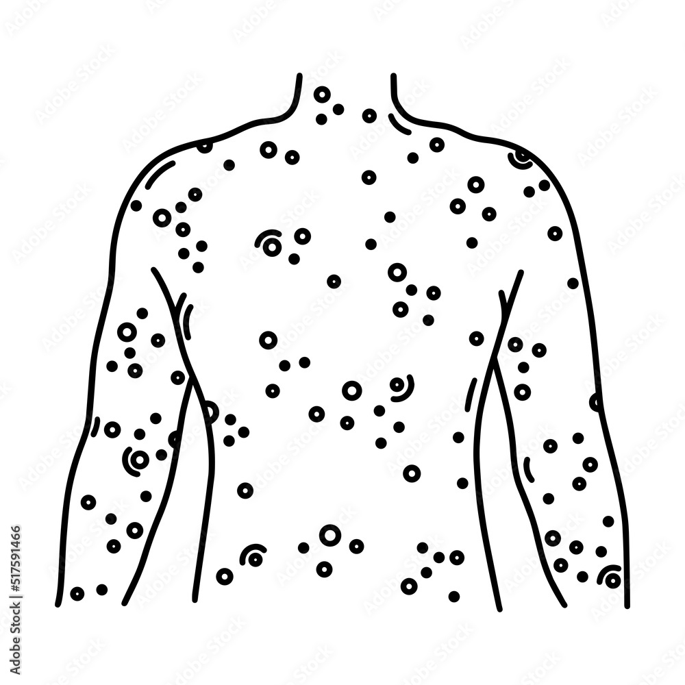 Body Rash Graphics Painful rash on back vector icon. Human torso with sores, ulcers ...