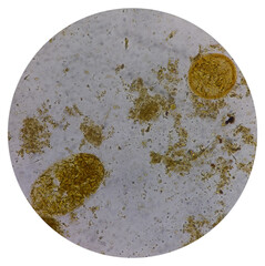 Poster - Vegetable cell of stool analysis under 40x light microscope, fecul vegetable cell. Microscopic finding of stool.